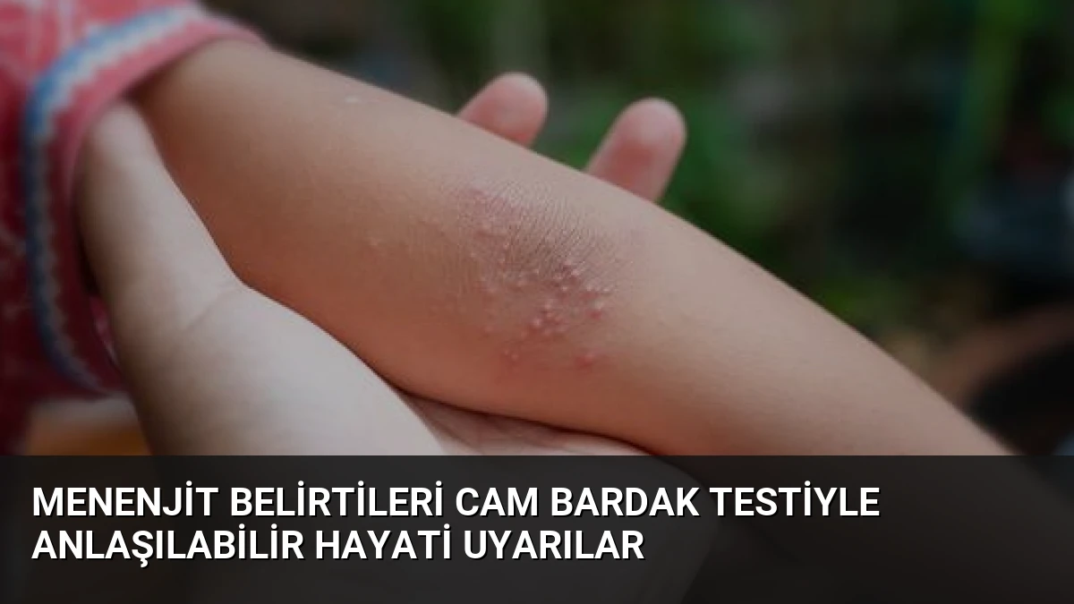Menenjit Belirtileri Cam Bardak Testiyle Anlaşılabilir Hayati Uyarılar