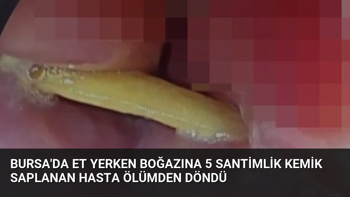 Bursa’da Et Yerken Boğazına 5 Santimlik Kemik Saplanan Hasta Ölümden Döndü