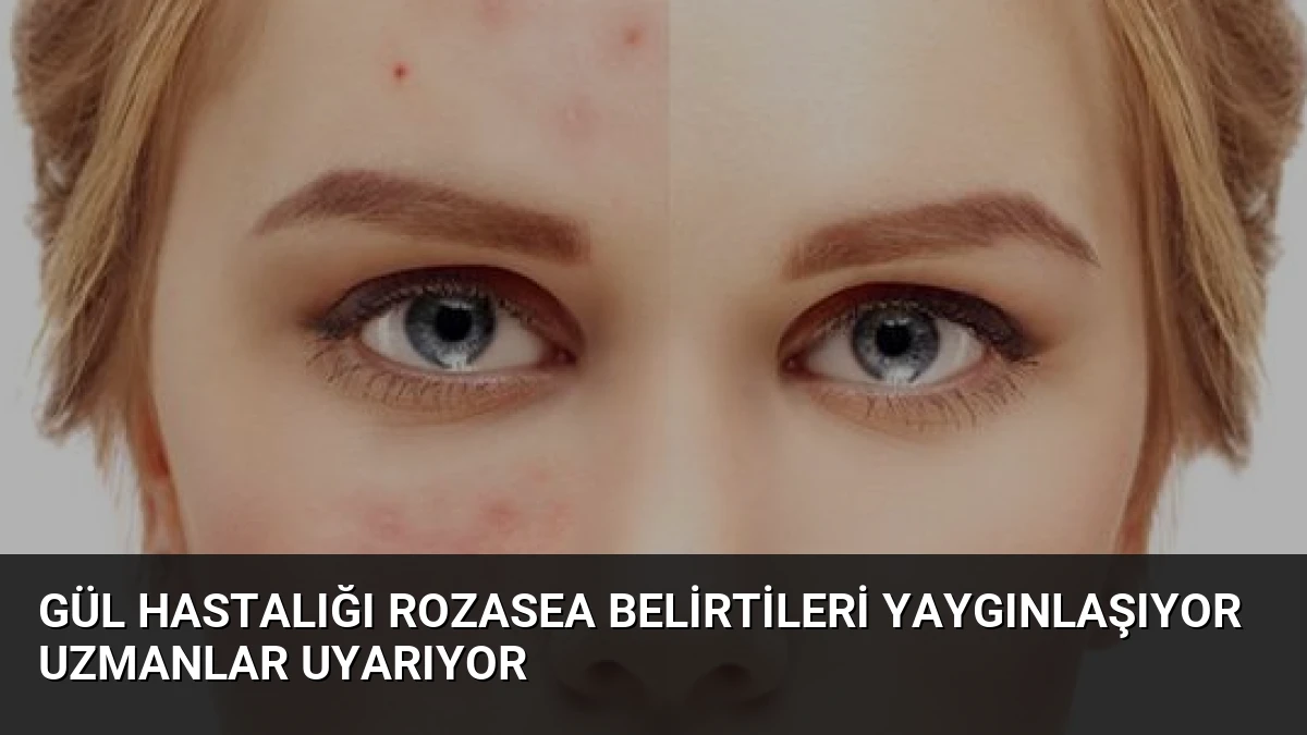 Gül Hastalığı Rozasea Belirtileri Yaygınlaşıyor Uzmanlar Uyarıyor