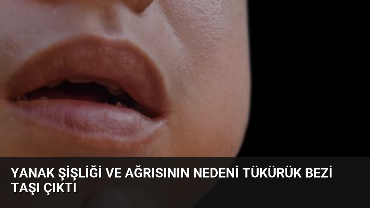 Yanak Şişliği ve Ağrısının Nedeni Tükürük Bezi Taşı Çıktı